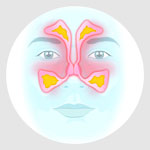 sinusitis